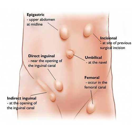 types-of-hernia